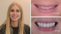 Veneers