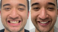 Dental Braces