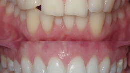 Composite Bonding