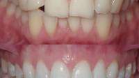 Composite Bonding