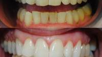 Teeth whitening