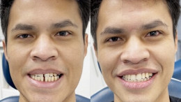 Composite Bonding