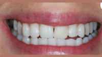 Invisalign