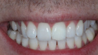 Teeth Whitening